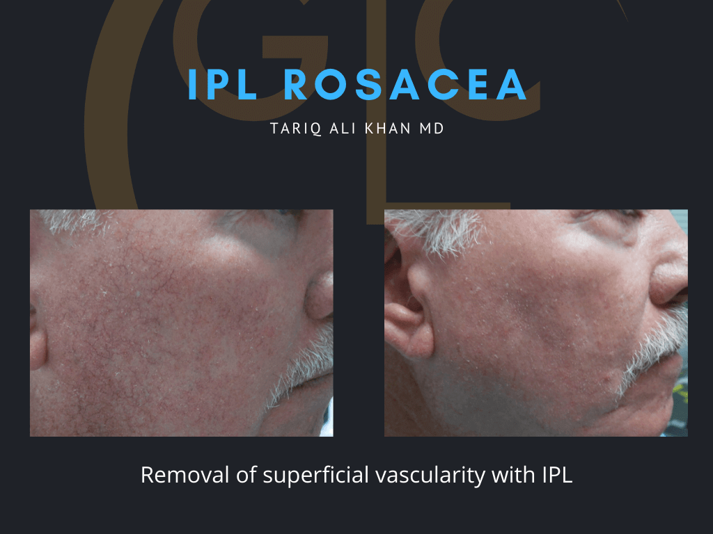 Gentle Care Laser Tustin & Long Beach Before and After picture - IPL Vascular